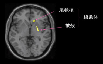 喫煙者においてニコチン摂取により線条体(尾状核・被殻)の[11C]ラクロプライドの受容体結合能が低下し、同部位でのドーパミンの放出が示唆された