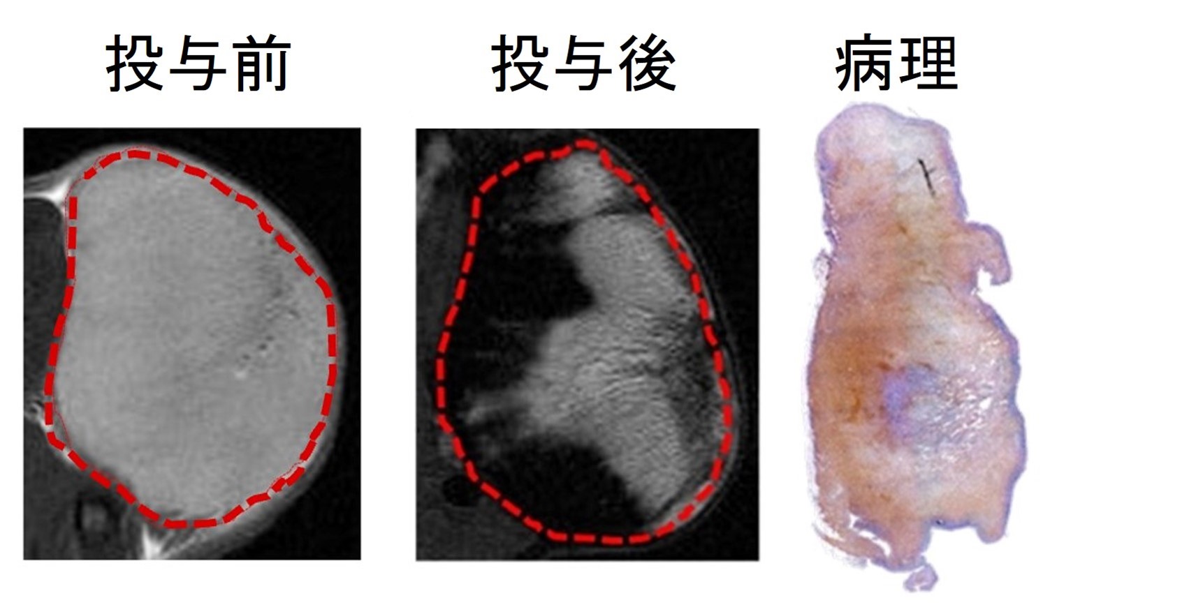 MRI画像と病理標本