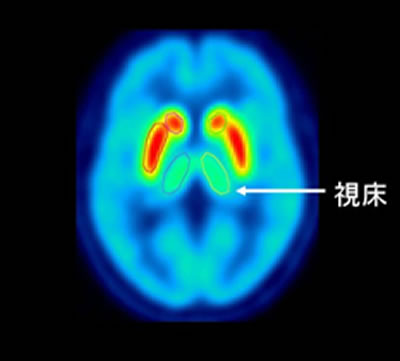 脳内の[11C]PE2IによるPET画像。