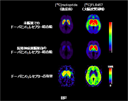 未服薬および抗神経病薬服薬後でのドーパミンD2受容体結合能の 脳内分布とこれらの画像データから計算されたドーパミンD2受容体占有率の脳内分布