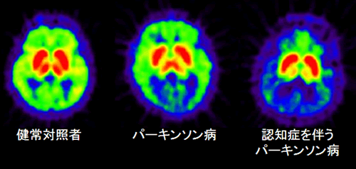 脳内の[11C]MP4AによるPET画像。