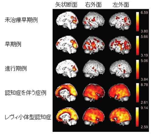 健常対照群と比較した患者群の脳内コリンエステラーゼ活性の低下部 位。