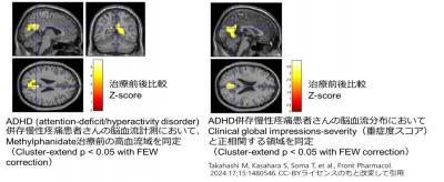 ADHD併存慢性疼痛における脳機能変化
