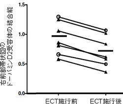 ECT施術前後でのドーパミンD2受容体結合能。ECT後には、ドーパミンD2受容体の結合能が減少していることが分かる。