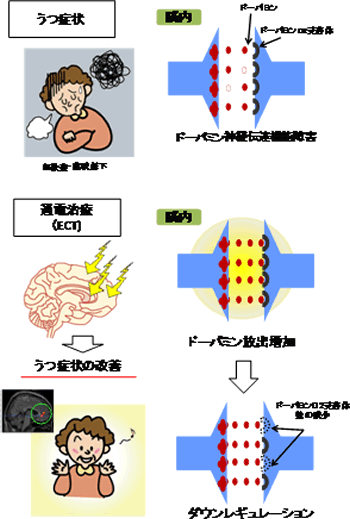 通電治療法の抗うつ効果 ドーパミン受容体が減少－難治性うつ病治療における通電治療法の役割解明へ－