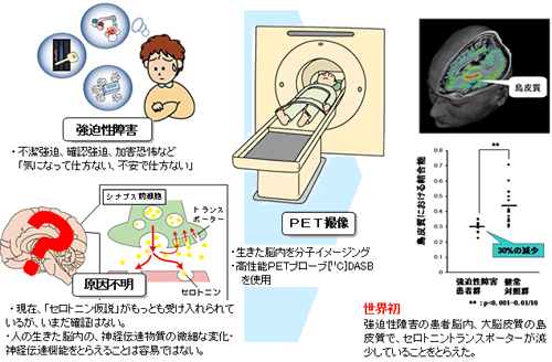 強迫性障害患者の脳内ではセロトニンを神経細胞内に取り込むタンパク質が減少する 量子科学技術研究開発機構