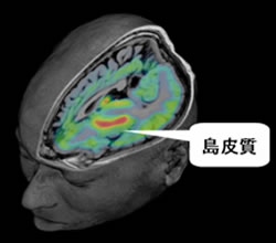 MRIと[11C]DASBを用いたPET画像の重ね合わせによる大脳 皮質の島皮質領域の図示。