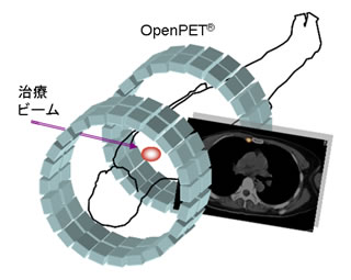 OpenPET®の今後の展開。PETで誘導しながら行う 新たな放射線がん治療(画像誘導治療)のイメージ