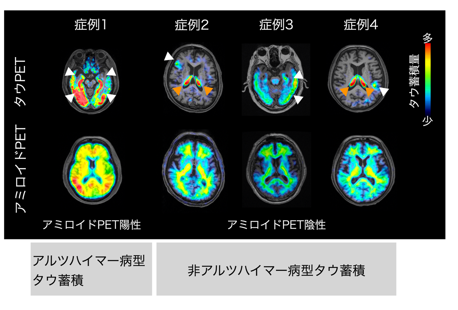 中高齢発症の気分障害にみられる多様なタウ病態