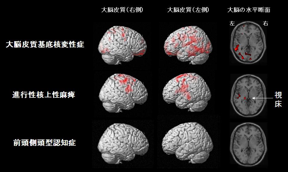 大脳のアセチルコリンエステラーゼ活性が低下している部位(赤い部分はPETによる検査で得られた信号で、活性低下部位を示す)