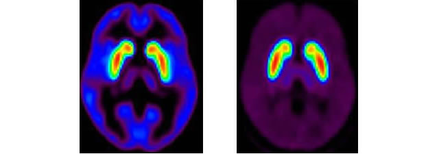 左：線条体ドーパミンD1受容体　　右：線条体ドーパミンD2受容体のPET画像