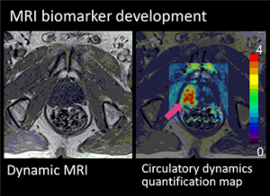 MRI　biomarker