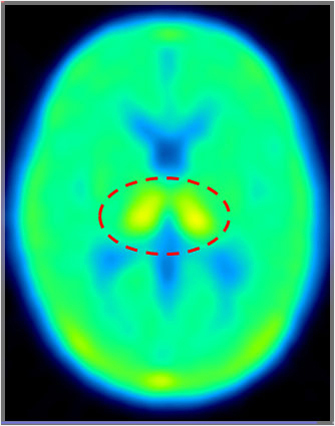 脳内NATのPET画像。点線内の黄色い部分が視床。