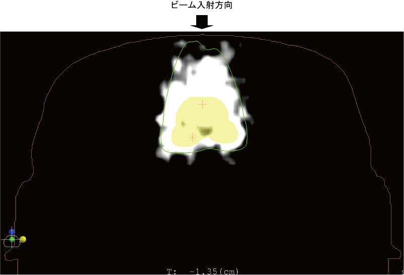 図の上方向から入射するビームを受けた患者さんの身体のPET-CTによる横断面画像。黄色の領域が治療ターゲットを、緑色の線が治療計画で設定した線量分布等高線（50％ライン）を示しています