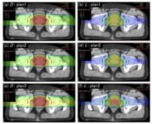 Dose distribution chart (a, c, e) and LET distribution chart (b, d, f) of three cases of multi-ion radiotherapy for prostate can