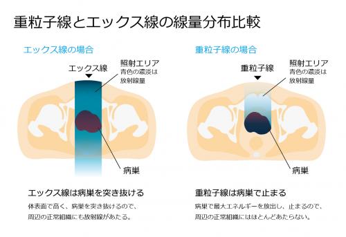 重粒子線とエックス線の線量分布比較