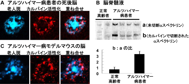 アルツハイマー病におけるカルパイン活性化