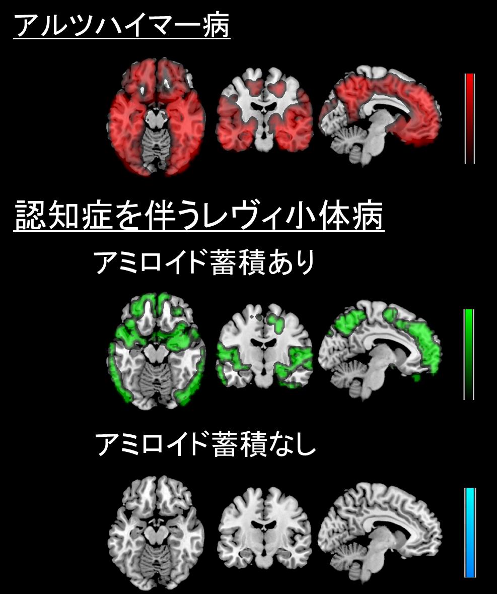 MRIで測定した脳萎縮（脳の下面、正面、側面から見た断面像）