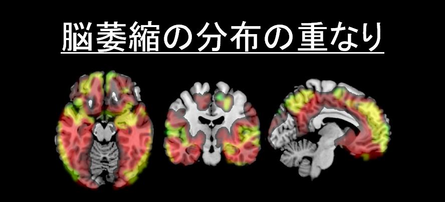 脳萎縮の分布の重なり（脳の下面、正面、側面から見た断面像）