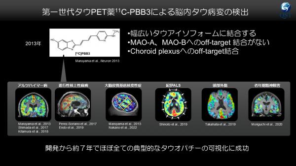 第一世代タウPET薬11C-PBB3による脳内タウ病変の検出