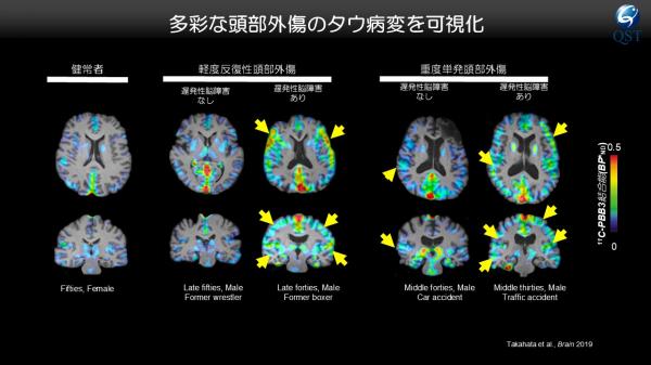 多彩な頭部外傷のタウ病変の検出