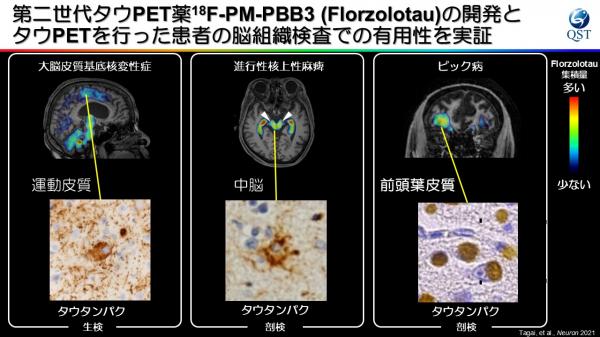 第２世代タウPET薬の開発とタウPETを行った患者の脳組織検査での有用性を実証