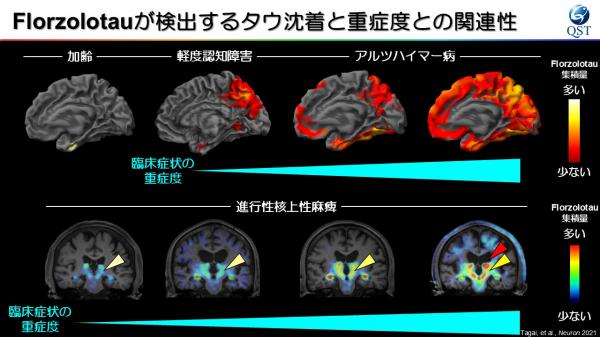 Florzolotauが検出するタウ沈着と重症度との関連性