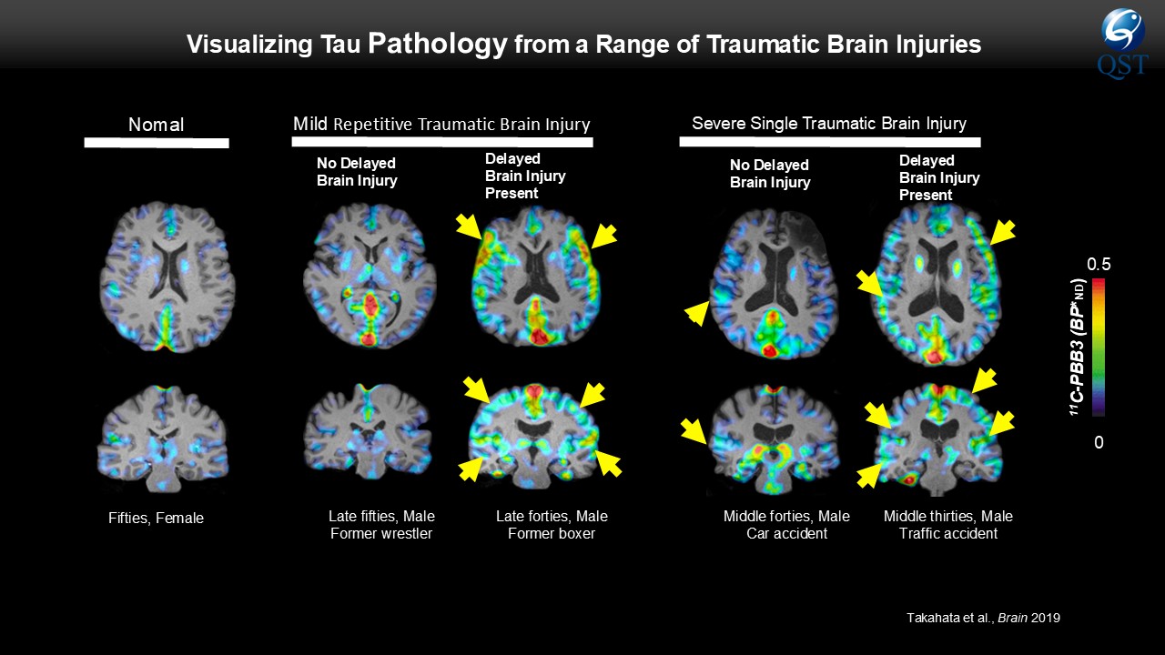 PET imaging for brain tau pathology of traumatic brain injuries