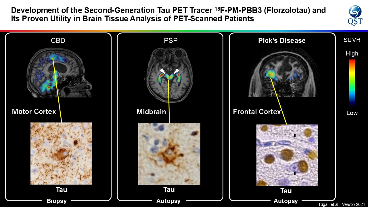 PET imaging for tau pathology by using second generation tau pep tracer