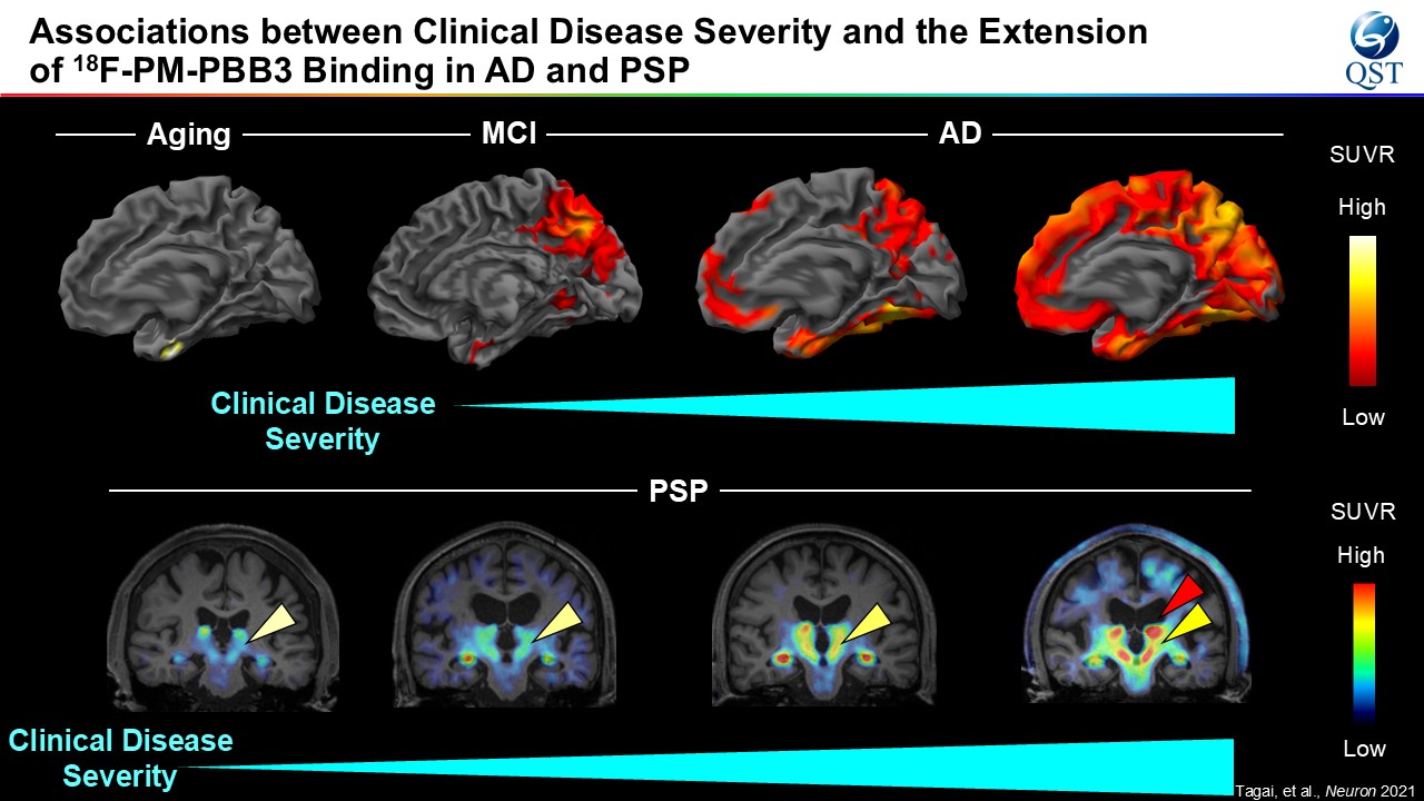 PET imaging for tau brain pathology extension in AD and PSP