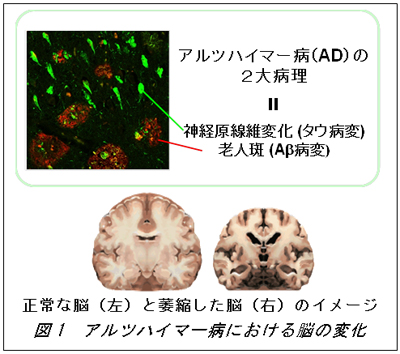 アルツハイマー病における脳の変化