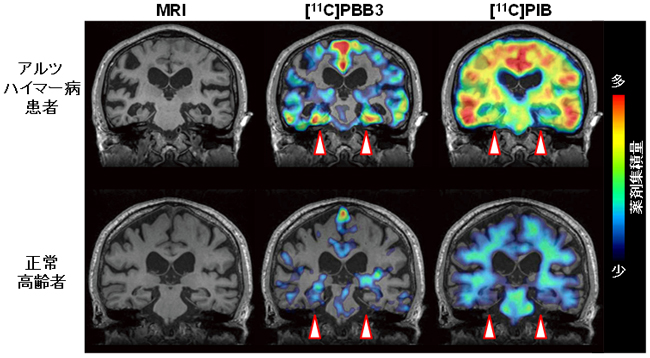 臨床研究で得られたMRIおよびPET画像