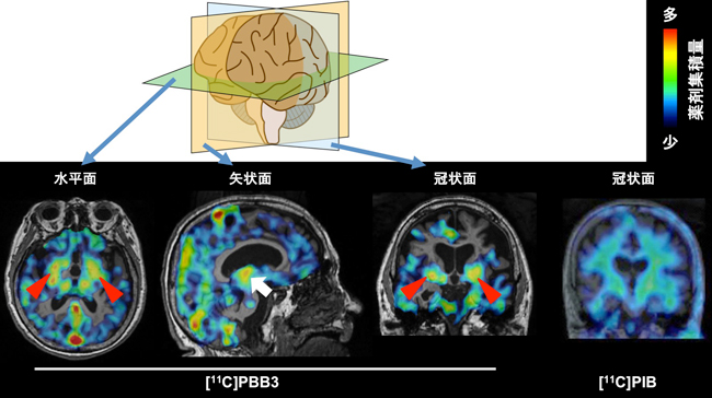 皮質基底核変性症(非アルツハイマー型認知症)の患者におけるPET画像