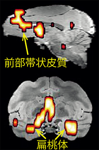 運動チックに比べて音声チック中に活動が過剰に亢進したモデルザルの脳部位