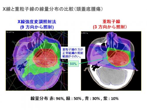 エックス線と重粒子線の頭蓋底腫瘍における治療計画図