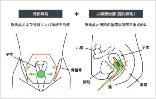子宮がんへの外部照射、腔内照射の模式図