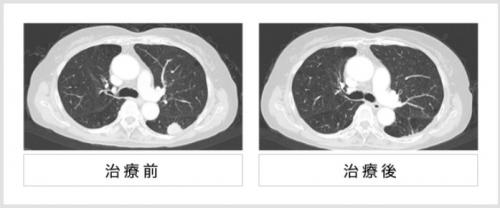 1A期肺腺癌に対する重粒子線1回照射治療前後のCT画像