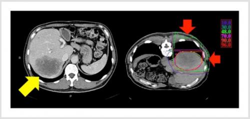 肝腫瘍に対する重粒子線治療の放射線線量分布の典型例