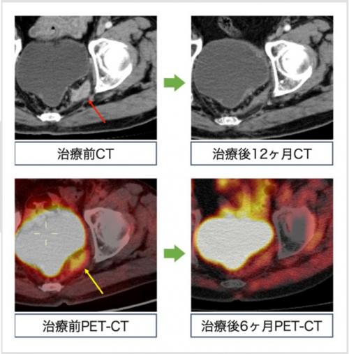 大腸がん術後骨盤内再発に対する重粒子線治療前後のCTおよびPET画像