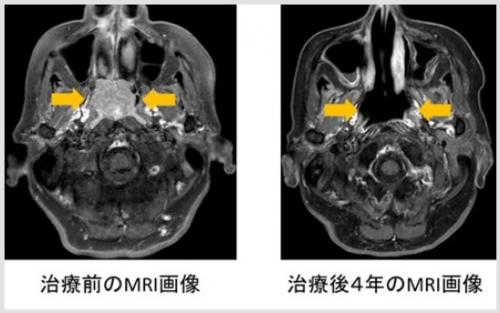 右鼻腔から上咽頭に進展する粘膜悪性黒色腫に対する重粒子線前後のMRI画像