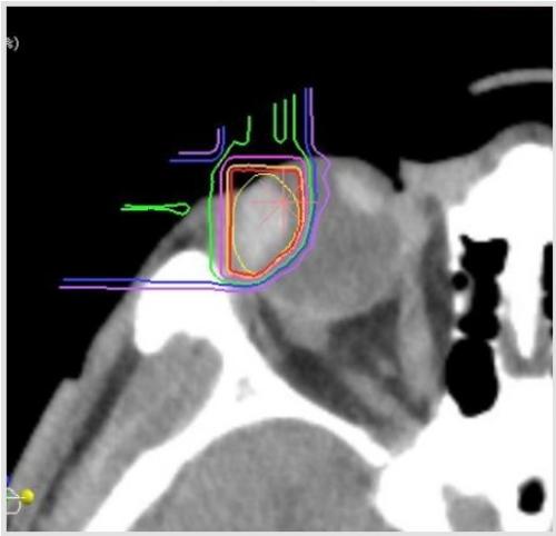脈絡膜悪性黒色腫に対する重粒子線治療の線量分布図