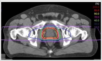 前立腺がんに対する重粒子線の線量分布図