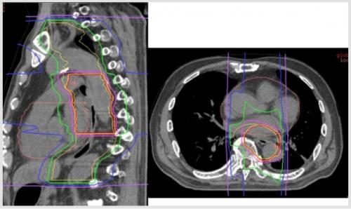 食道がんに対する重粒子線の線量分布図