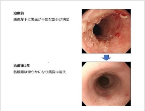 食道がんに対する重粒子治療前後の内視鏡画像
