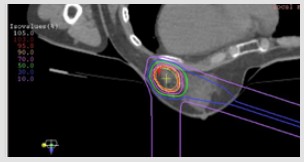乳がんに対する重粒子線の線量分布図