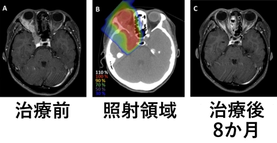涙腺がん治療前後と照射領域の画像