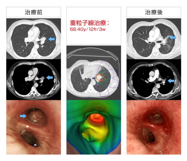 cT2aN1M0IIA期扁平上皮肺がん、重粒子線照射治療前後のCT、内視鏡
