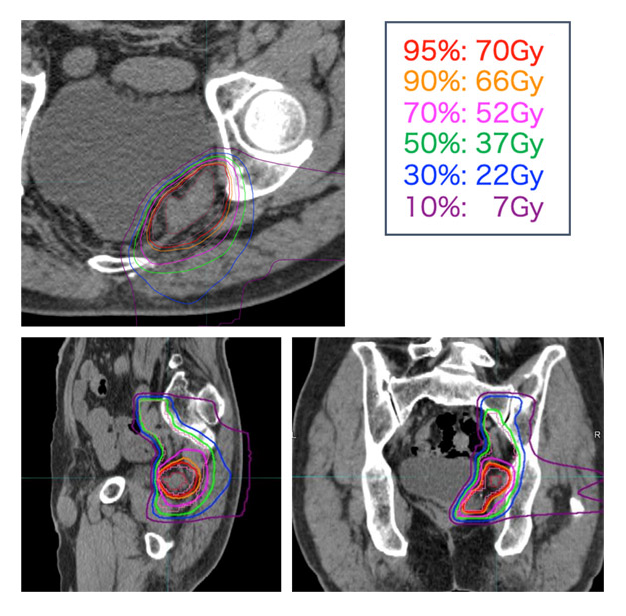 大腸がん術後骨盤内再発に対する重粒子線の線量分布例