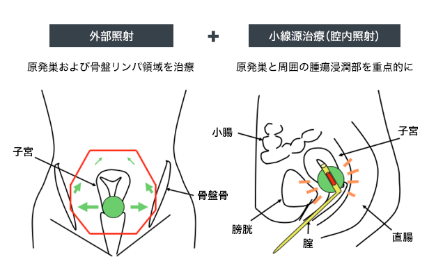 子宮がんへの外部照射、腔内照射の模式図
