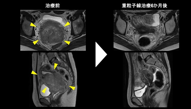 子宮頸がんの治療前と重中止線治療6か月後のMRI画像
